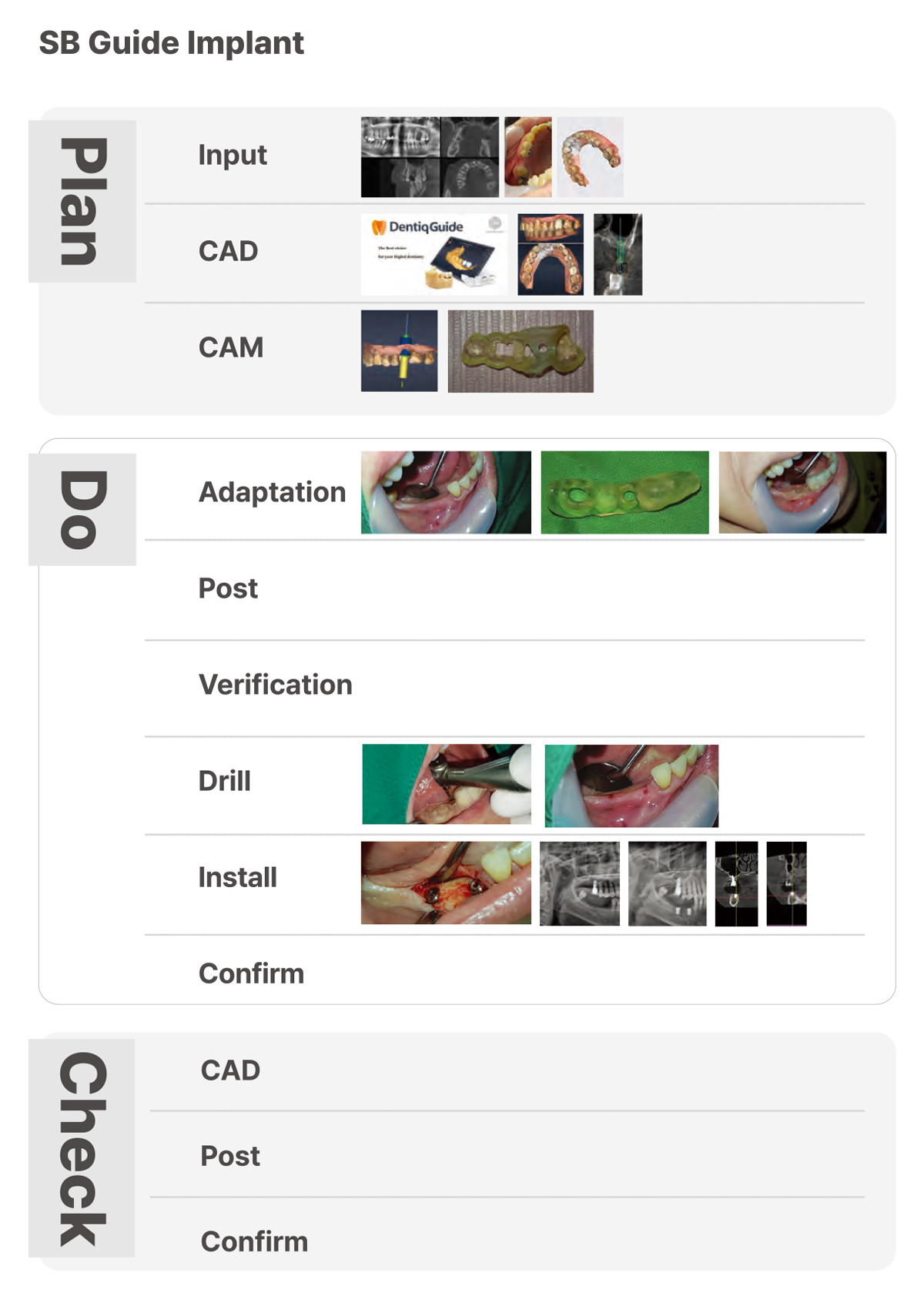 sb guide implant. 1) plan (1) input (2) CAD (3) CAM 2) do (1) adaptation (2) post (3) verification (4) drill (5) install (6) confirm 3) check (1) CAD (2) post (3) confirm